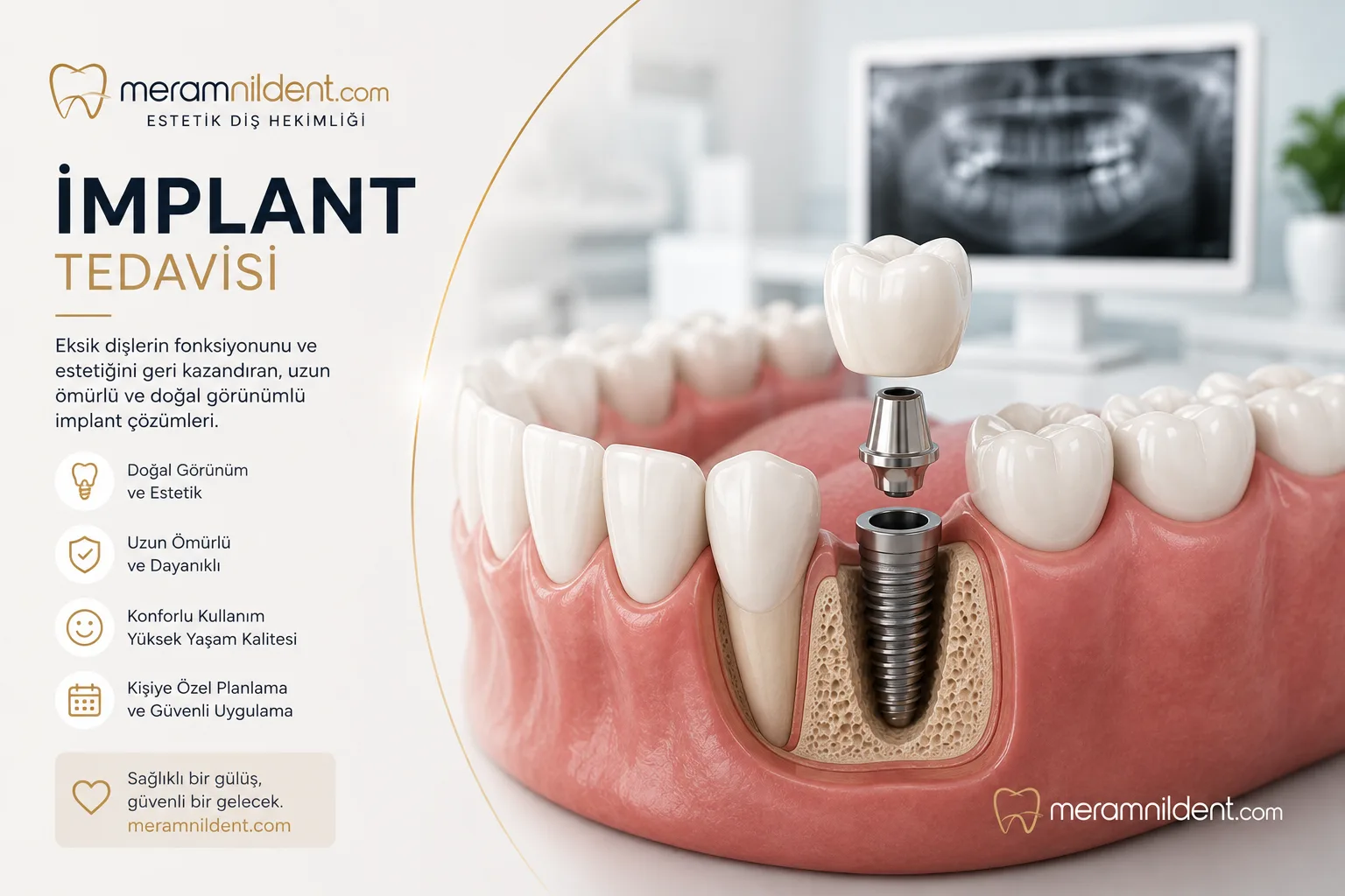 İmplant Tedavisi
